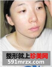 注射痩脸切开法双眼皮整形手术前后对比照