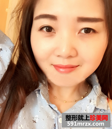 打瘦脸针前后对比图 圆脸快速变成了小V脸 