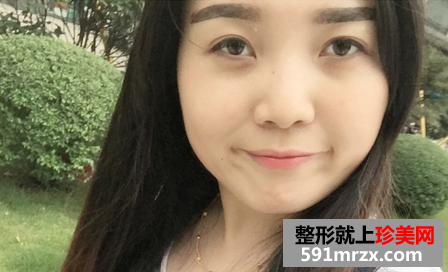 打瘦脸针前后对比图 圆脸快速变成了小V脸 