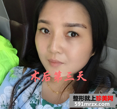 打瘦脸针前后对比图 圆脸快速变成了小V脸 