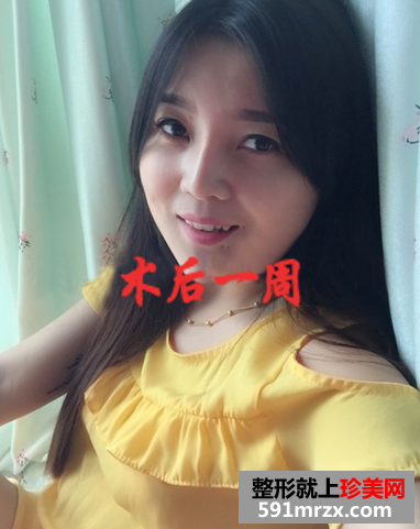 打瘦脸针前后对比图 圆脸快速变成了小V脸 
