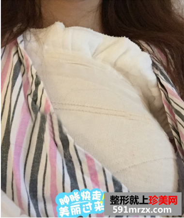 假体隆胸后恢复过程图 隆胸后和平胸说拜拜
