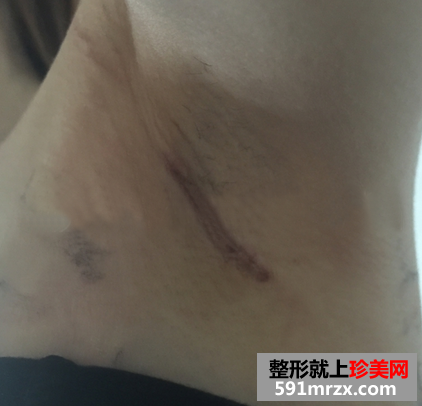 假体隆胸后恢复过程图 隆胸后和平胸说拜拜