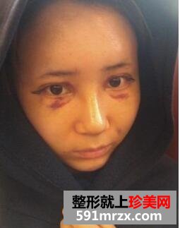 粉红宝宝相媲美 脸部安全整形术后分享