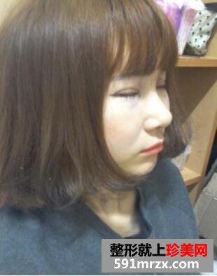 粉红宝宝相媲美 脸部安全整形术后分享