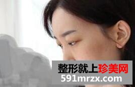 白富美养成记 面部整形手术前后对比照