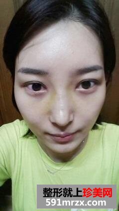 白富美养成记 面部整形手术前后对比照