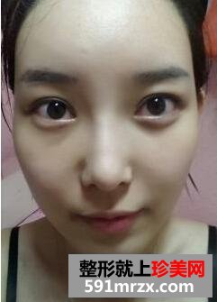 白富美养成记 面部整形手术前后对比照