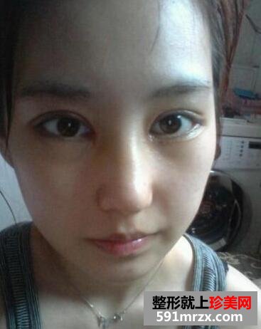 小眼睛怎么做双眼皮 塌鼻子隆鼻前后对比案例分享