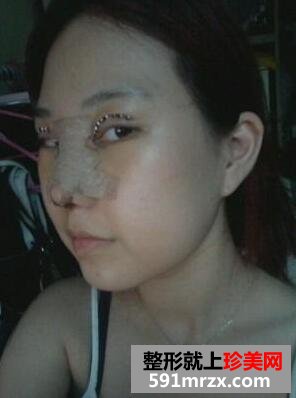 小眼睛怎么做双眼皮 塌鼻子隆鼻前后对比案例分享