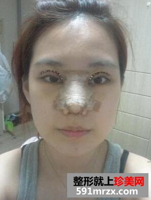 小眼睛怎么做双眼皮 塌鼻子隆鼻前后对比案例分享