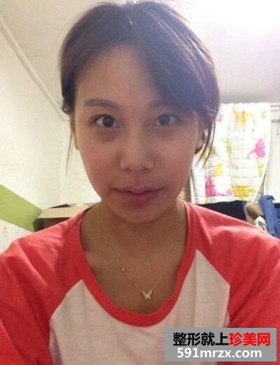 最新面部整形日记 切开法双眼皮+宽鼻梁矫正+硅胶隆鼻