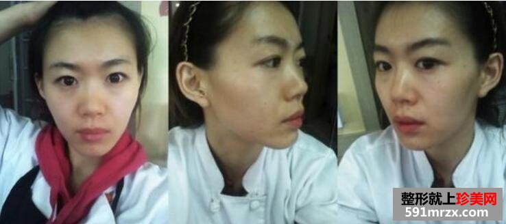 脸部自体脂肪移植+硅胶隆鼻恢复全过程分享对比图
