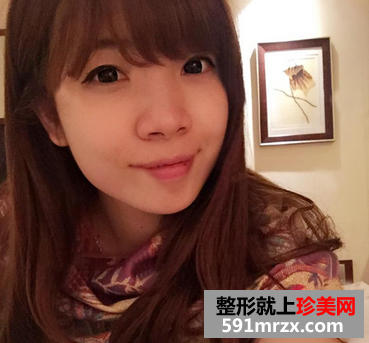 假体丰下巴+鼻翼缩小手术前后对比案例分享