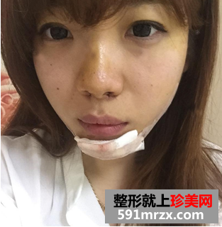 假体丰下巴+鼻翼缩小手术前后对比案例分享