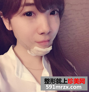 假体丰下巴+鼻翼缩小手术前后对比案例分享