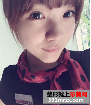 假体丰下巴+鼻翼缩小手术前后对比案例分享