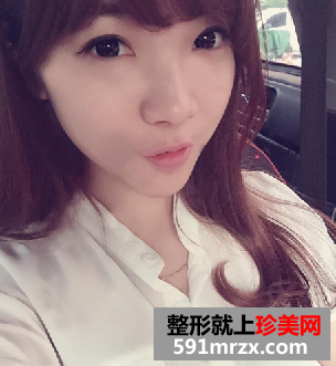 假体丰下巴+鼻翼缩小手术前后对比案例分享