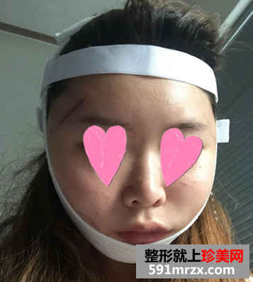 颧骨整形日记 颧骨+Vline手术