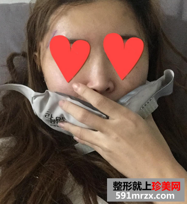 颧骨整形日记 颧骨+Vline手术