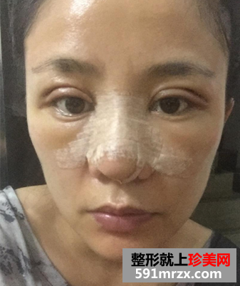 我的双眼皮+隆鼻修复经历