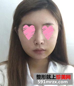 颧骨整形日记 颧骨+Vline手术