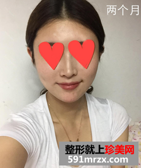 颧骨整形日记 颧骨+Vline手术