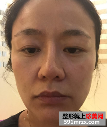 我的双眼皮+隆鼻修复经历