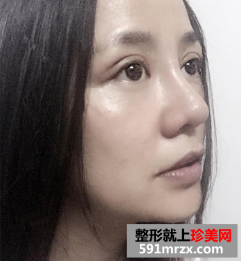 我的双眼皮+隆鼻修复经历
