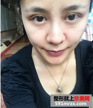 我的双眼皮+隆鼻修复经历