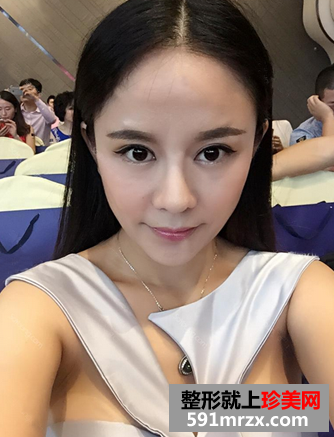 我的双眼皮+隆鼻修复经历