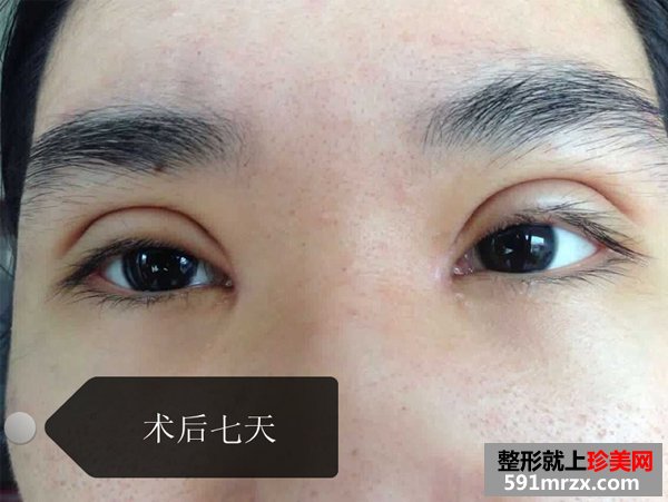 双眼皮+上睑下垂矫正前后对比照 
