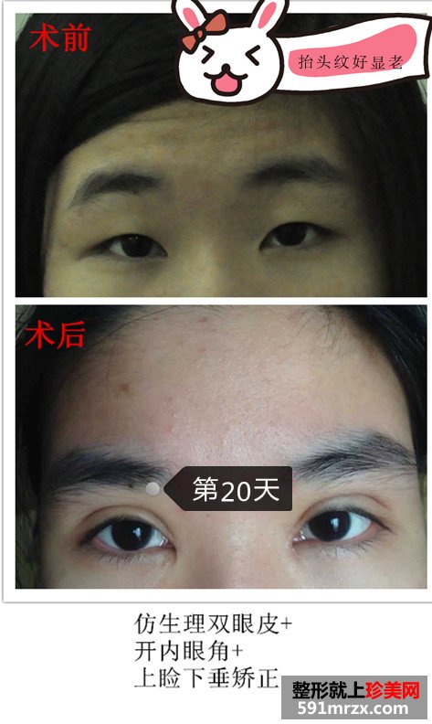 双眼皮+上睑下垂矫正前后对比照 