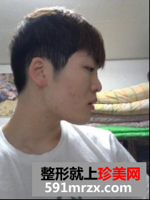 颧骨+下颚内缩+自体丰额头+埋线法双眼皮 术后的恢复经历