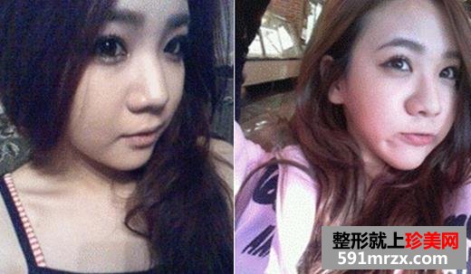 综合隆鼻恢复过程 硅胶隆鼻+鼻尖软骨+鼻翼缩小
