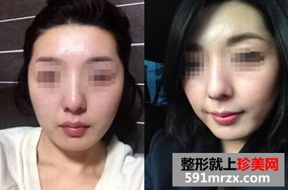 打瘦脸针前后对比图 让我摆脱大饼脸