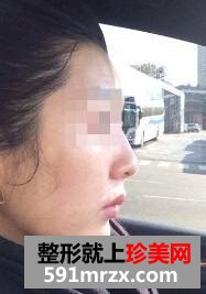 打瘦脸针前后对比图 让我摆脱大饼脸