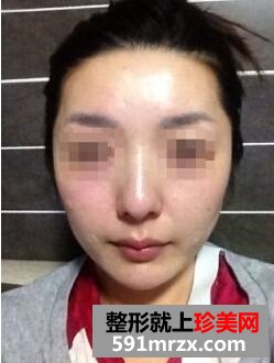打瘦脸针前后对比图 让我摆脱大饼脸