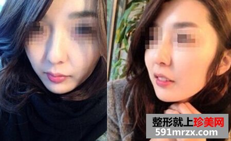 打瘦脸针前后对比图 让我摆脱大饼脸