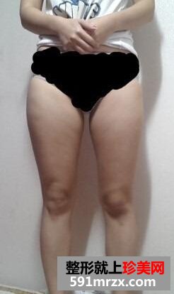腿部吸脂+自体脂肪丰臀恢复经历