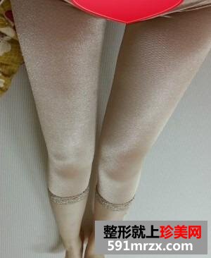 腿部吸脂+自体脂肪丰臀恢复经历
