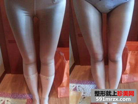 腿部吸脂+自体脂肪丰臀恢复经历
