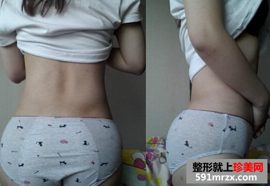 腿部吸脂+自体脂肪丰臀恢复经历