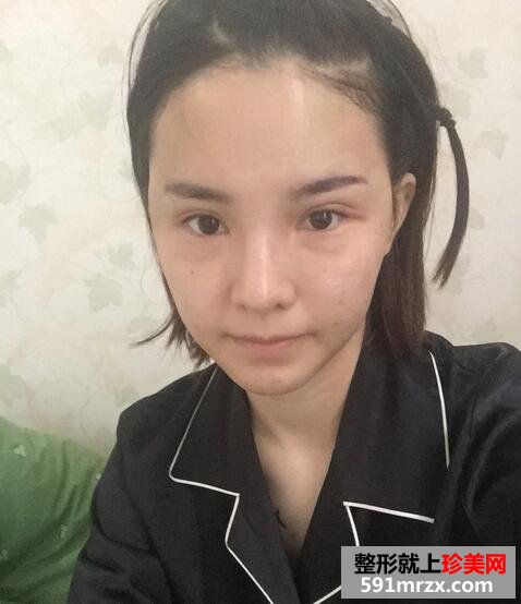 太阳穴额头脂肪填充，完成混血风蜕变【诗颜网】