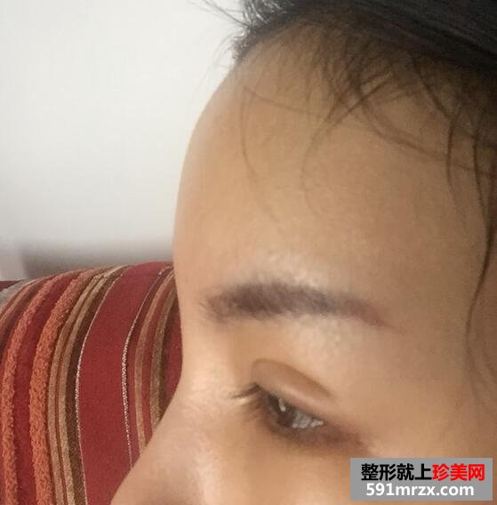 太阳穴额头脂肪填充，完成混血风蜕变【诗颜网】