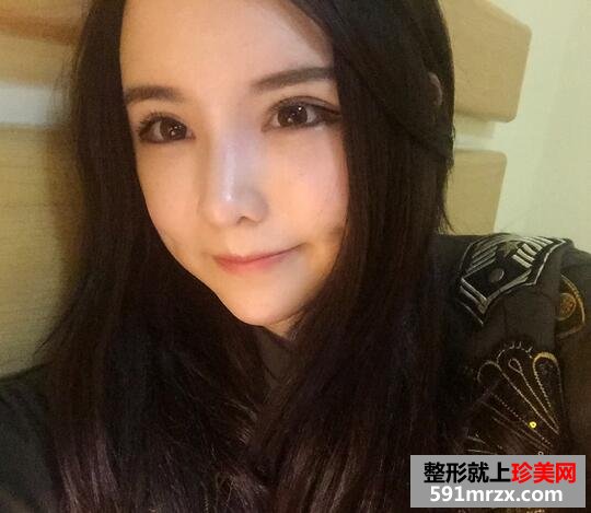 太阳穴额头脂肪填充，完成混血风蜕变【诗颜网】