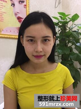 玻尿酸垫下巴，告别小方脸~【诗颜网】