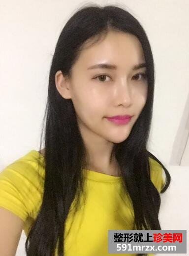 玻尿酸垫下巴，告别小方脸~【诗颜网】