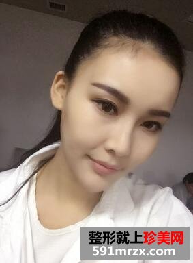 玻尿酸垫下巴，告别小方脸~【诗颜网】