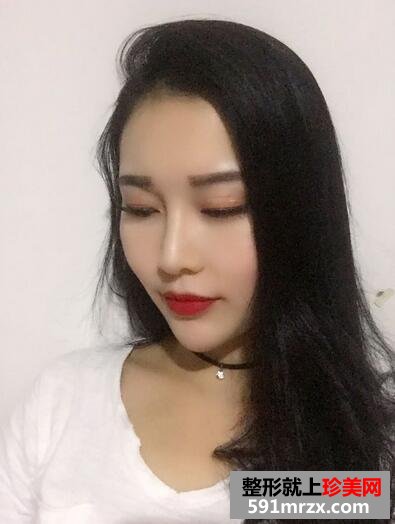 玻尿酸垫下巴，告别小方脸~【诗颜网】
